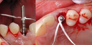 teeth implants & veneers Adelaide